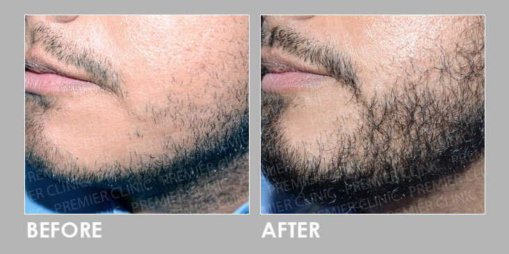 FUE BEARD TRANSPLANT before & after