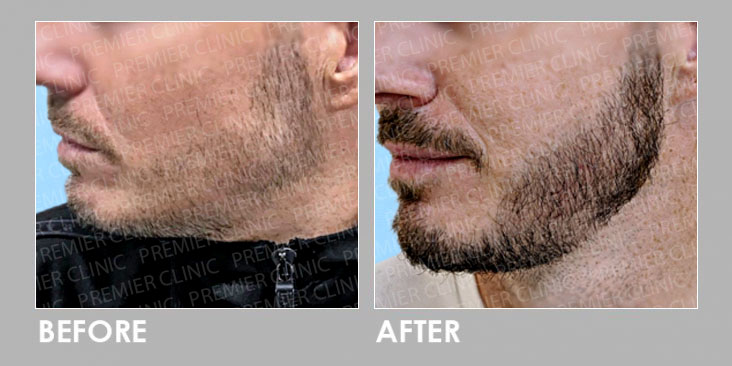 FUE BEARD TRANSPLANT before & after