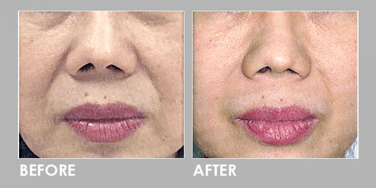 Fotona Facelift Before & After