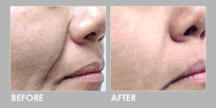 Fotona Facelift Before & After
