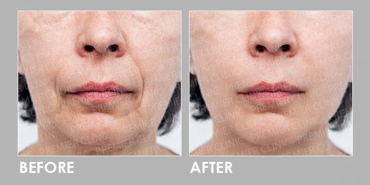 Fotona Facelift Before & After