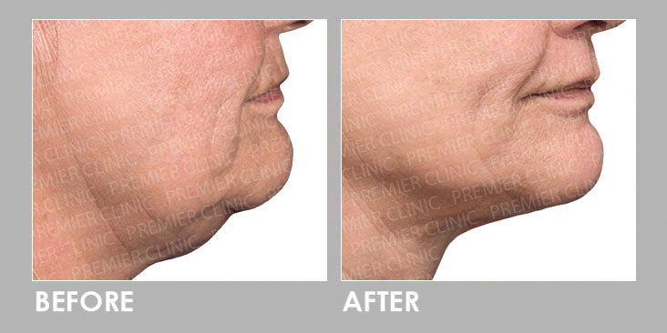 Fotona Facelift Before & After