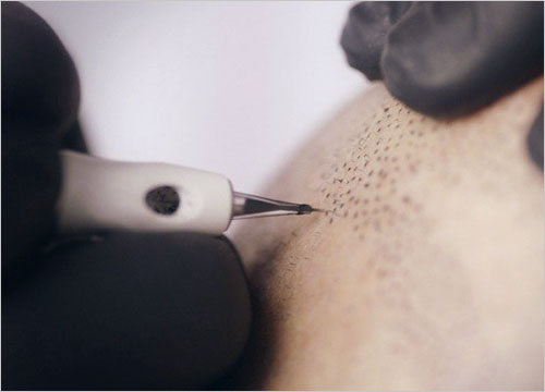 Hair Follicles Enhancer (Scalp Micropigmentation) 