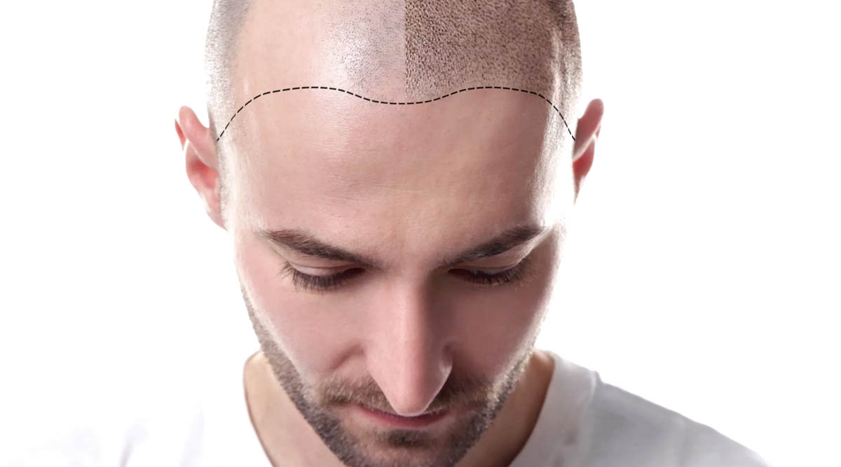 Hair Follicles Enhancer (Scalp Micropigmentation) 