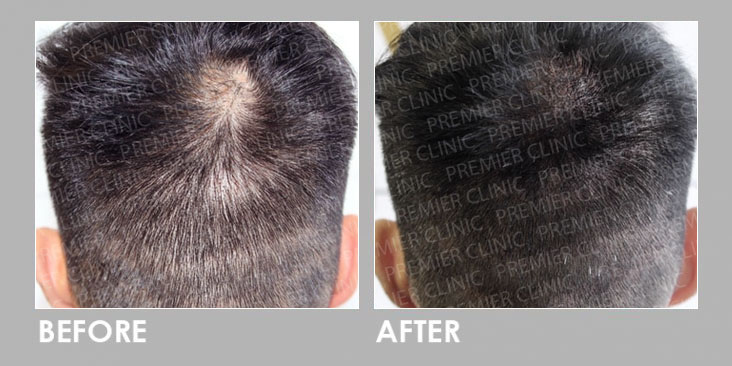Hair Follicles Enhancer (Scalp Micropigmentation) before & after