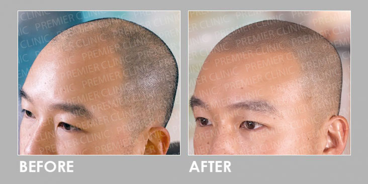Hair Follicles Enhancer (Scalp Micropigmentation) before & after