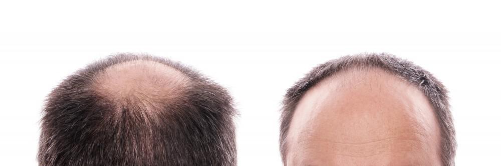 Hair Loss In Male