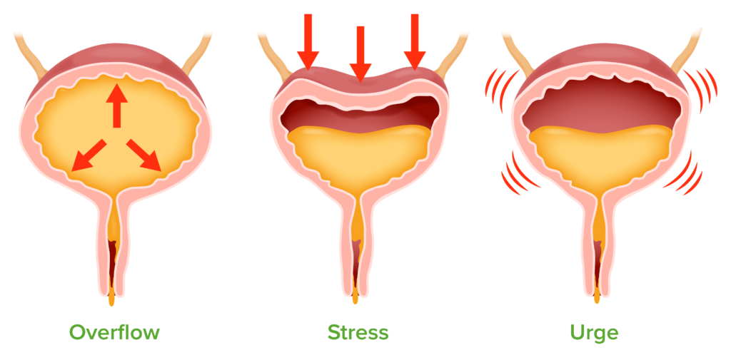 OVERFLOW INCONTINENCE