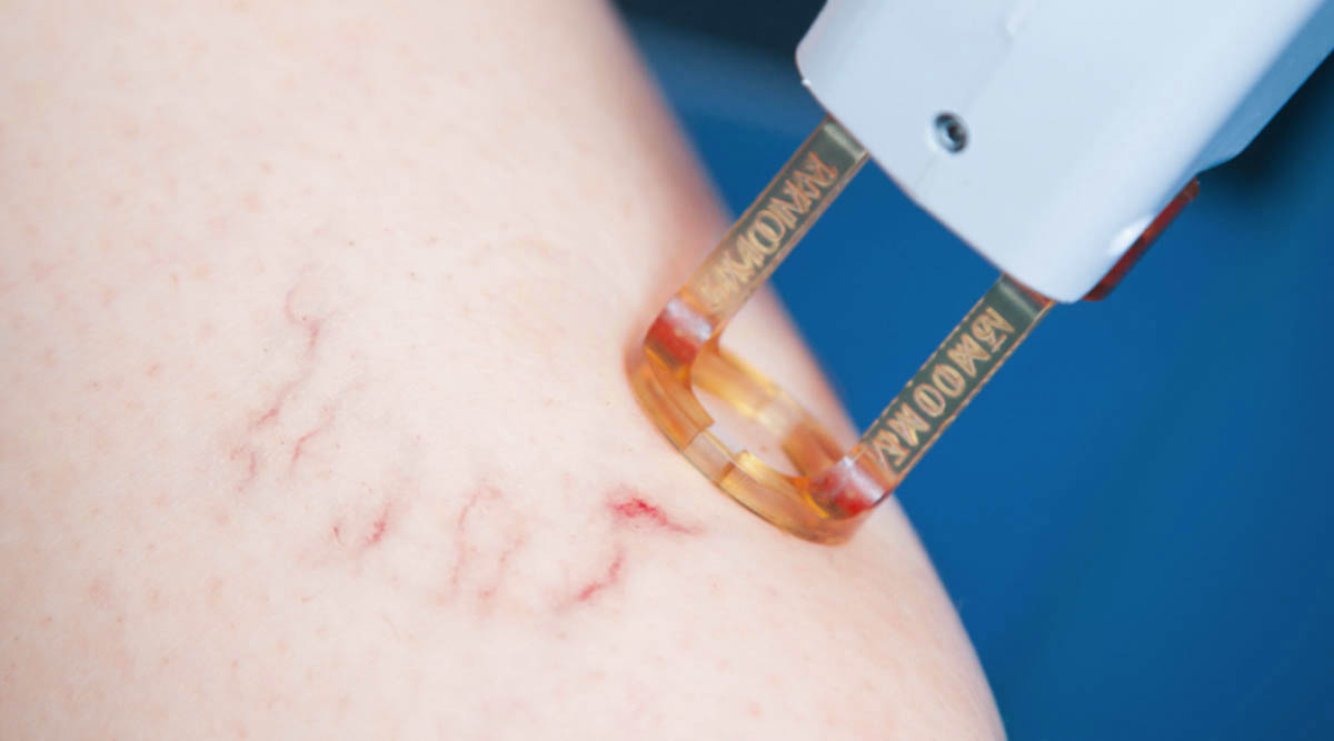 VARICOSE VEIN LASER