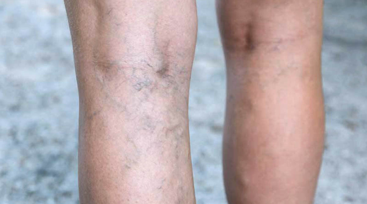 VARICOSE VEIN LASER