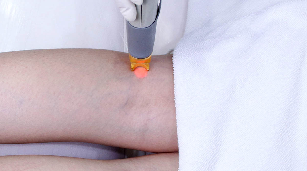 VARICOSE VEIN LASER