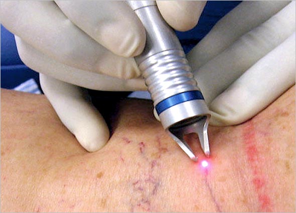 VARICOSE VEIN LASER