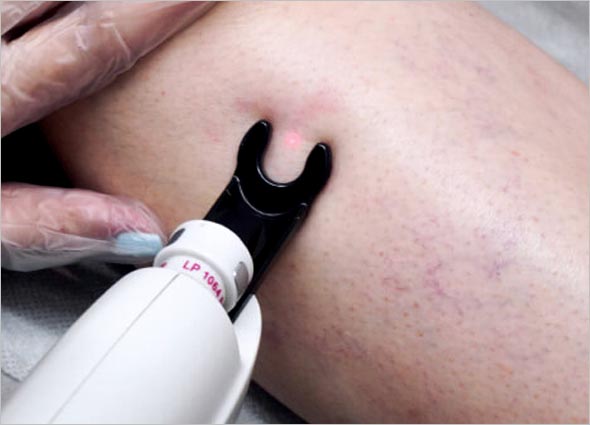 VARICOSE VEIN LASER
