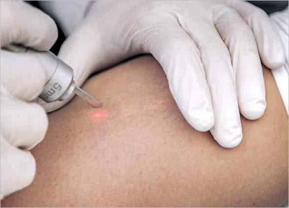 VARICOSE VEIN LASER