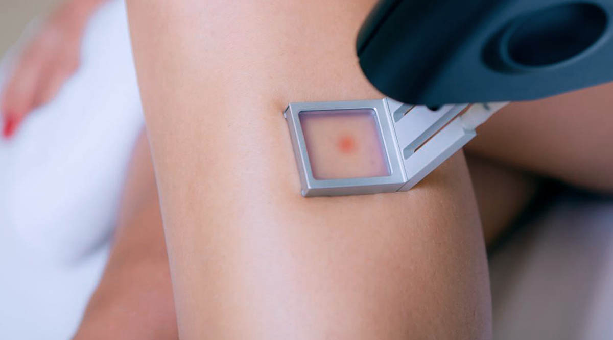 VARICOSE VEIN LASER