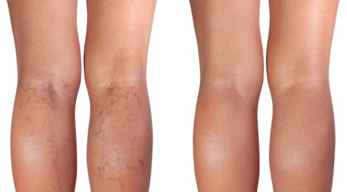 VARICOSE VEIN LASER