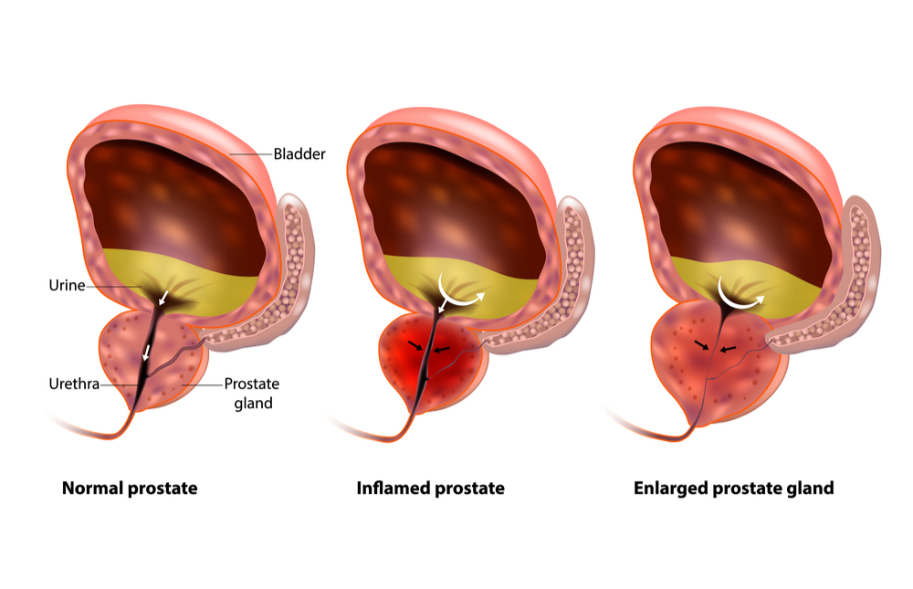 ENLARGED PROSTATE