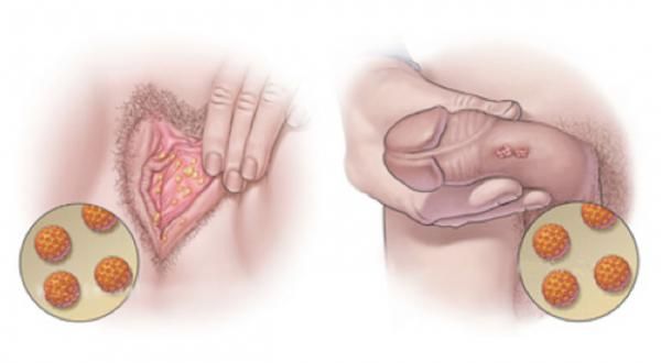 GENITAL WARTS