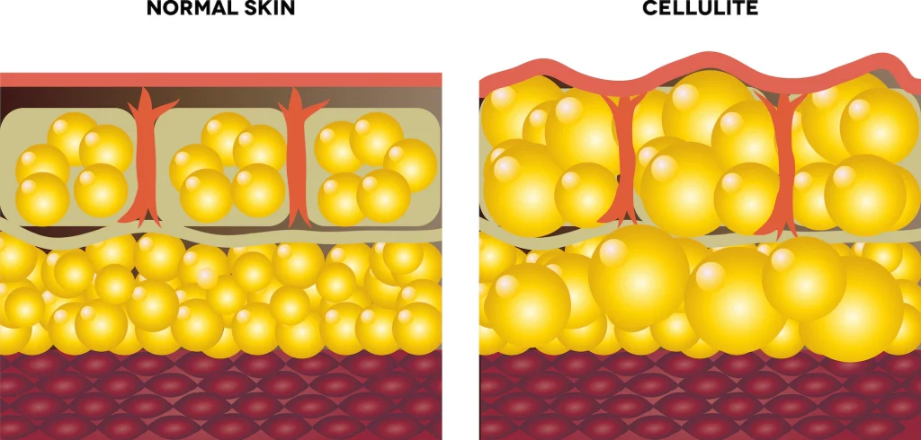 CELLULITE fat