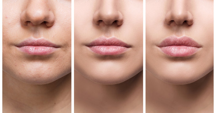lip filler asian