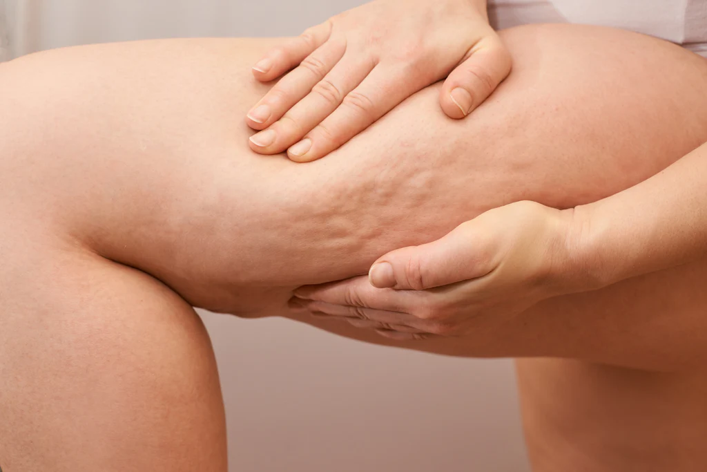 Stretch Marks And Cellulite