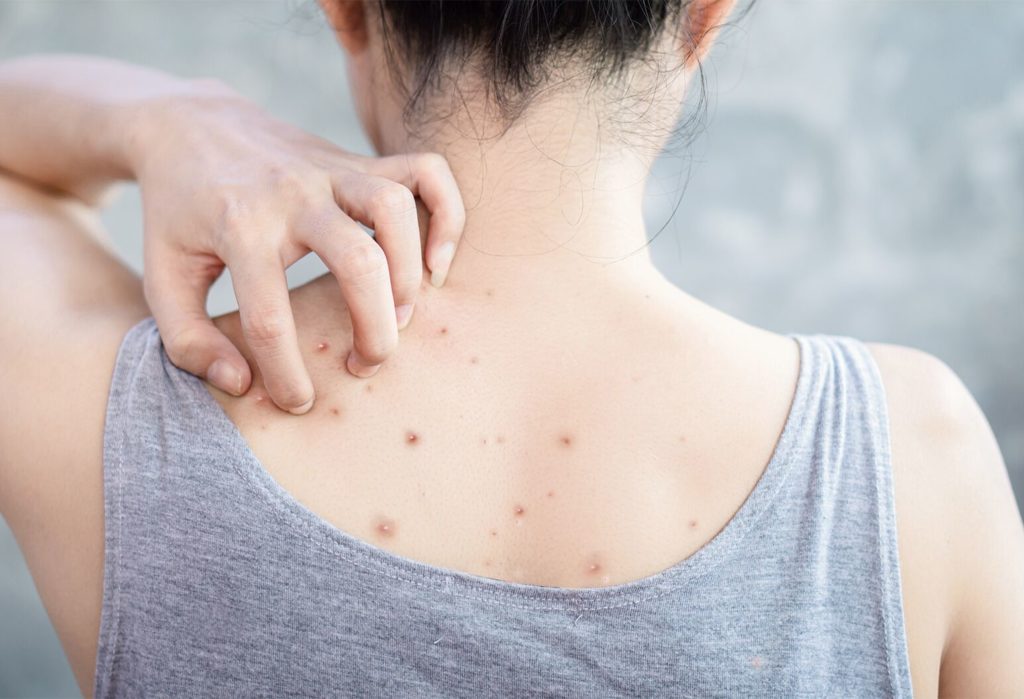 6 DIFFERENT TYPES OF BACK ACNE