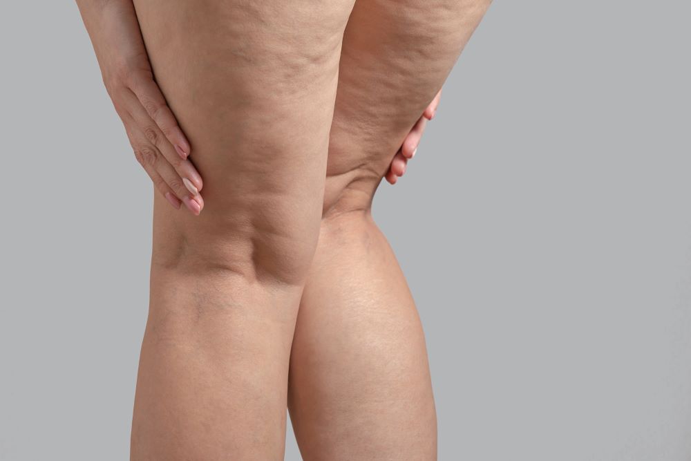 How-to-Get-Rid-of-Cellulite-and-Stretch-Marks