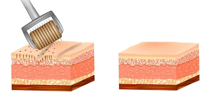 DERMAROLLING