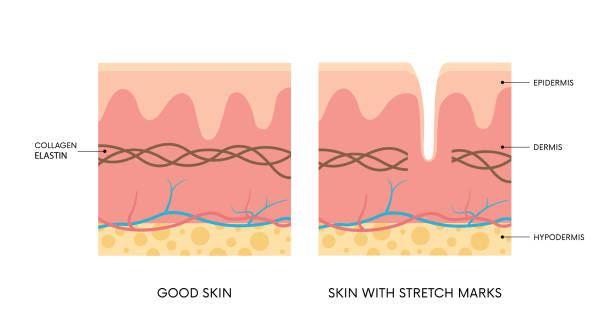 STRETCH MARKS