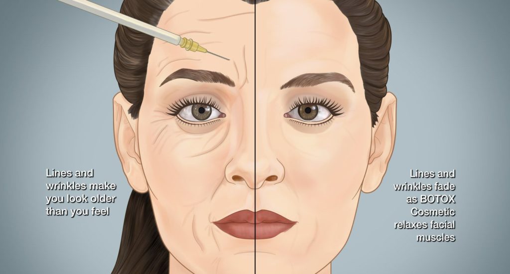 10 Common Myths About Botox