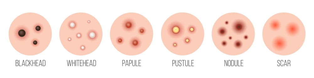 6 DIFFERENT TYPES OF BACK ACNE