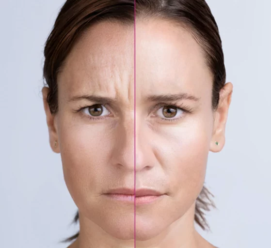 BOTOX IS PERMANENT