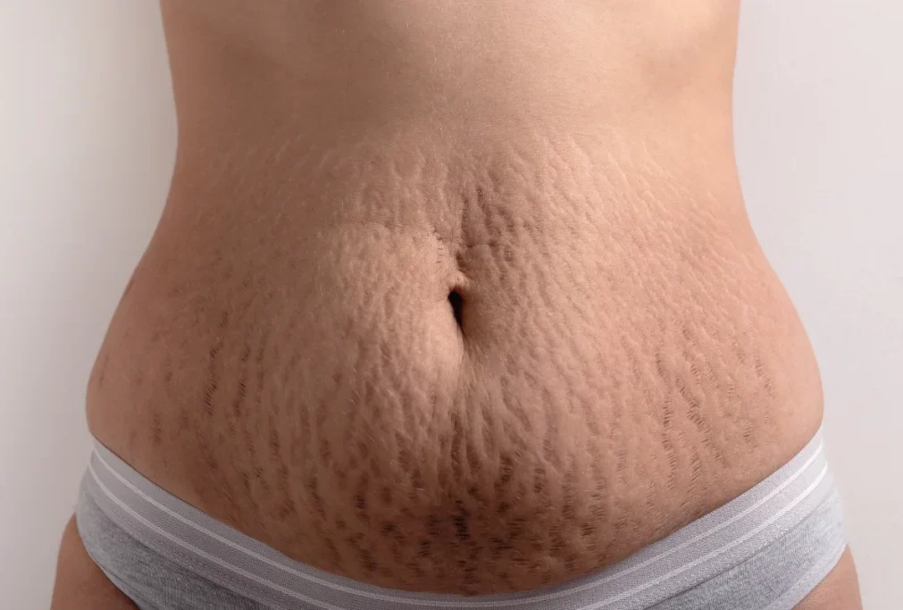 Stretch Marks