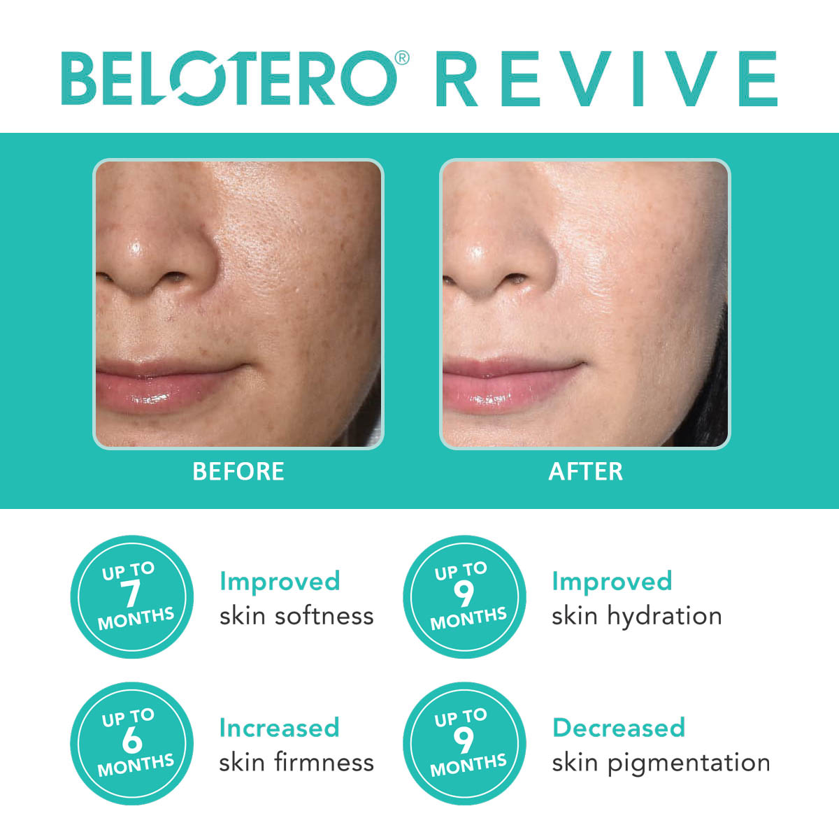 BELOTERO® REVIVE