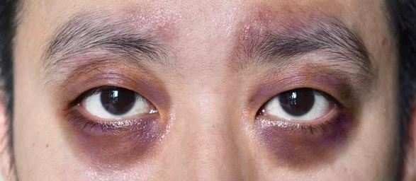 Panda Eyes