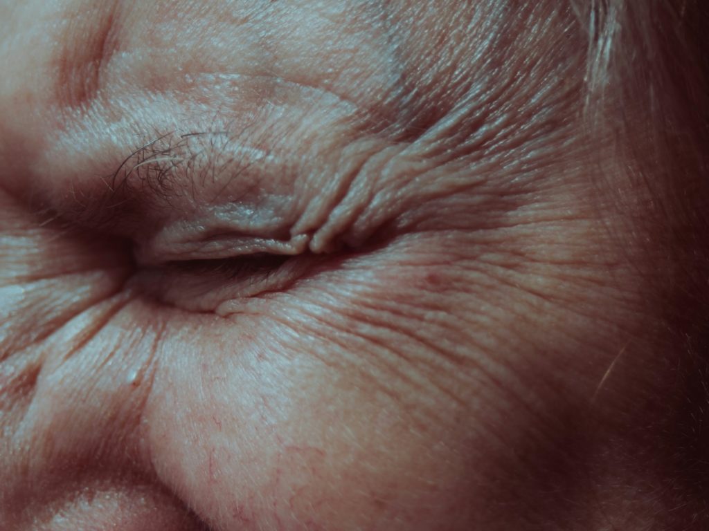 Sagging Skin: Before Muscle Toning Treatment