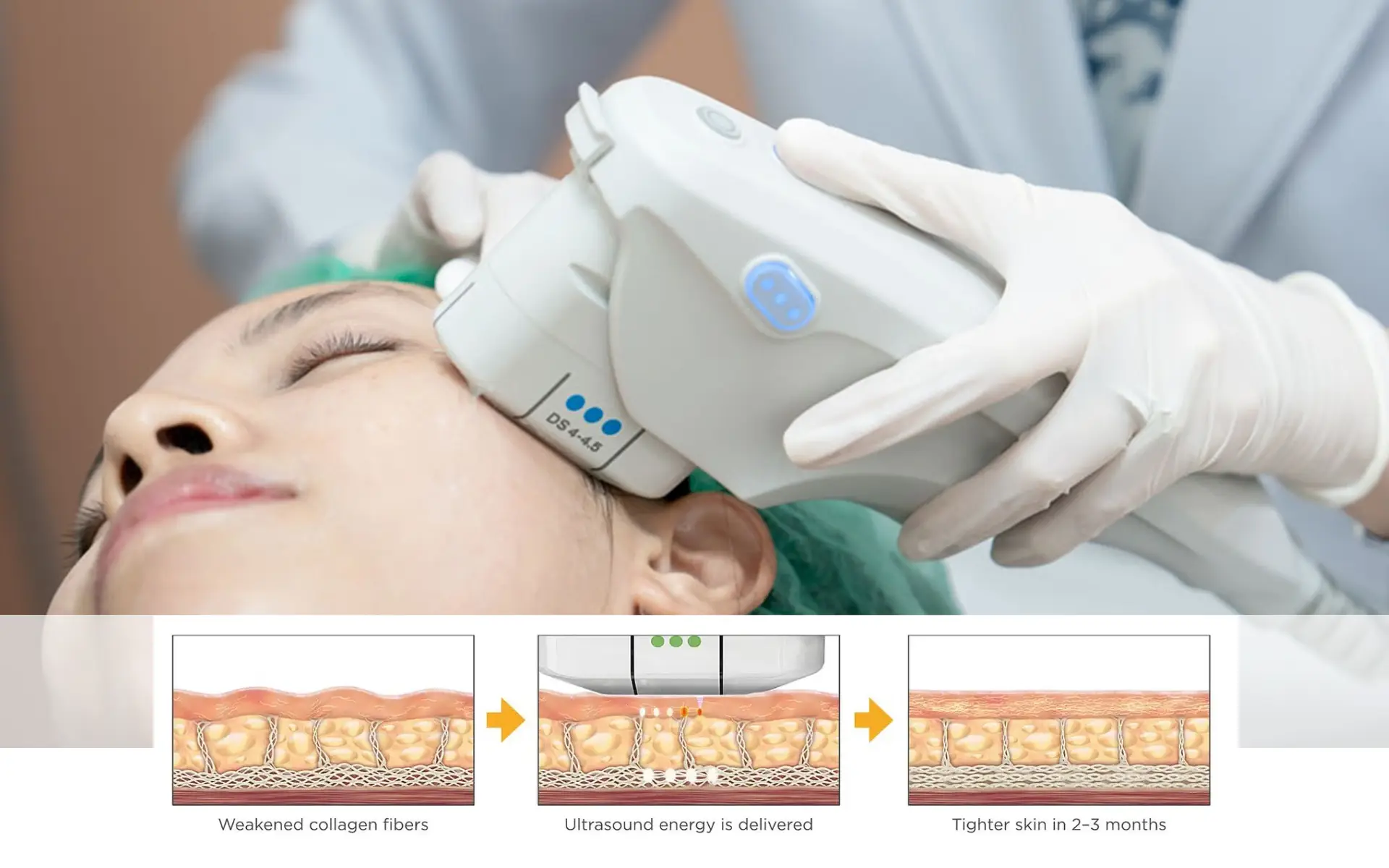 Ultherapy PRIME procedure illustration showing how ultrasound targets deep skin layers
