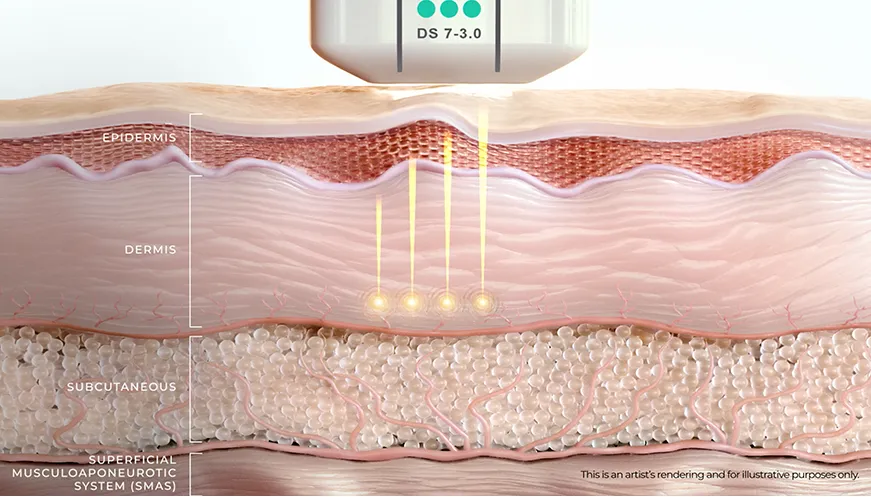 Medical professional performing Ultherapy PRIME with unmatched precision for skin lifting treatment
